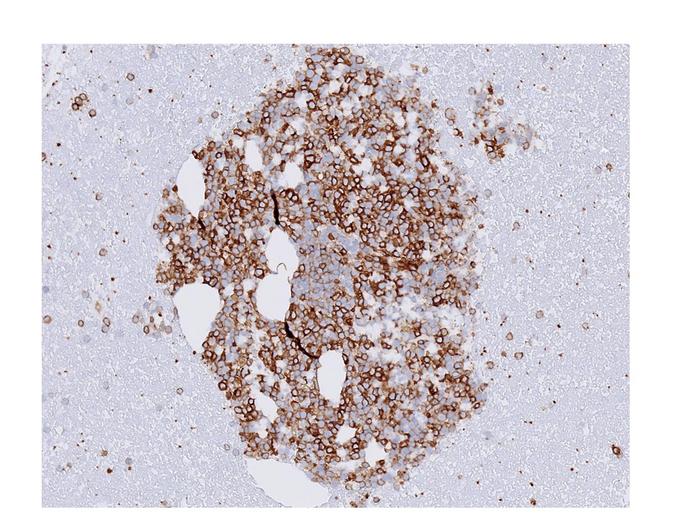 Leukemia Cells
