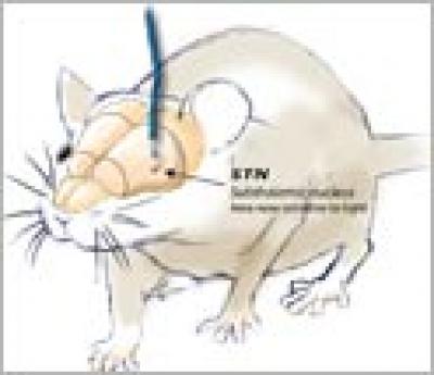 Parkinson's