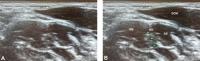 Ultrasound of Newly Identified Variation that Can Predispose Patients to Thoracic Outlet Syndrome