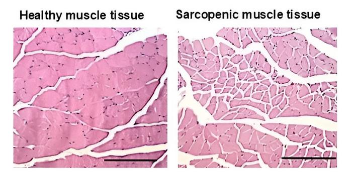 Healthy and sarcopenic muscle tissue