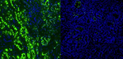 Cancer Cells
