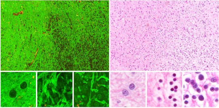 Images Reveal the High Density of Tumor Cells