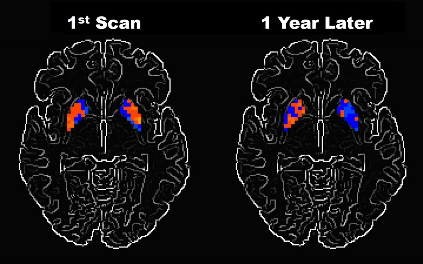 Tracking Brain Changes in People with Parkinson's