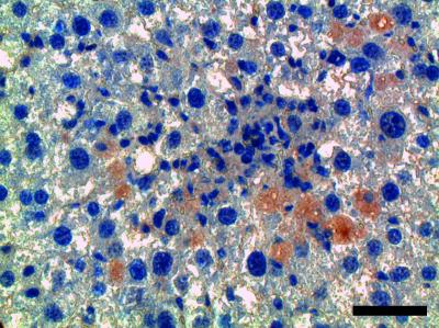 IL-33 in Damaged Liver