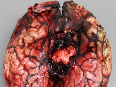 Gross and Histopathologic Features of Acute Fatal <i>Exserohilum</i> Meningitis