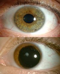 Aniridic Eye