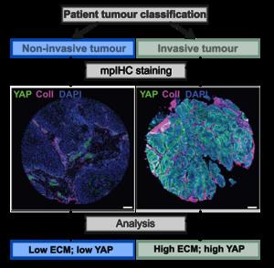 An outline of an approach to understanding the properties of human laryngeal tumours.