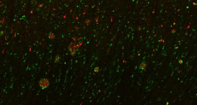 PLD3 gene contributes to risk of Alzheimer's disease