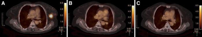 68Ga-HER2 PET/CT images before neoadjuvant therapy, at end of second cycle, and before surgery