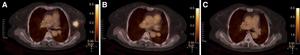 68Ga-HER2 PET/CT Predicts Breast Cancer Treatment Response