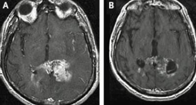 Glioblastoma-Erlotinib