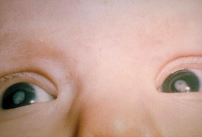 Cataracts