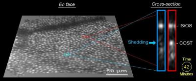 Time-Lapse 3-D Imaging Detects Disc Shedding of Photoreceptor Cells in the Living Human Eye