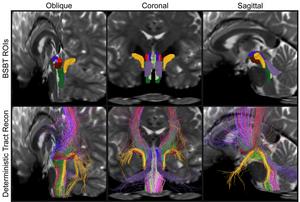 Brainstem bundles