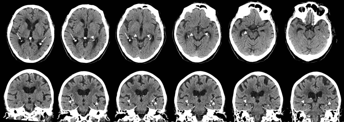 Axial and Coronal CT Images in 76-Year-Old Man Show Severe Hippocampal Calcification
