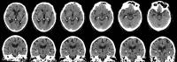 Axial and Coronal CT Images in 76-Year-Old Man Show Severe Hippocampal Calcification
