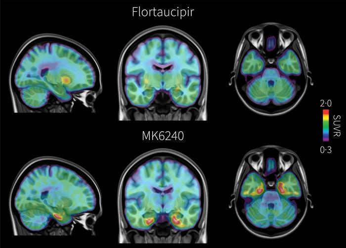 PET brain scans comparing tau pathology detected with flortaucipir and MK-6240 in early Alzheimer’s disease