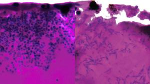 Candida auris diuring infection