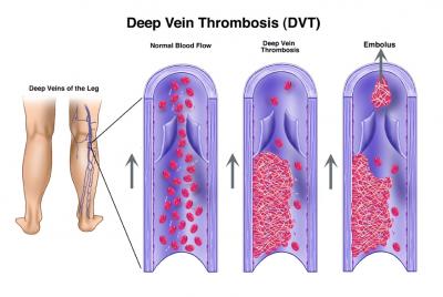 Deep Vein Thrombosis