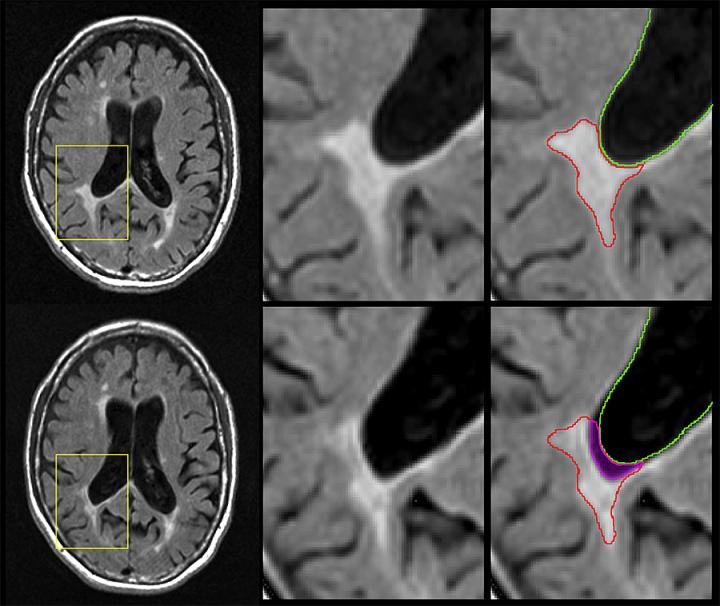 In MS, Disintegrating Brain Lesions May Indicate the Disease is Getting Worse