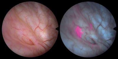 Bladder Cancer Made Detectable