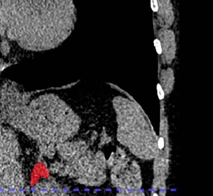 Left adrenal automated 2D segmentation in chest CT.