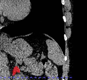 Left adrenal automated 2D segmentation in chest CT.