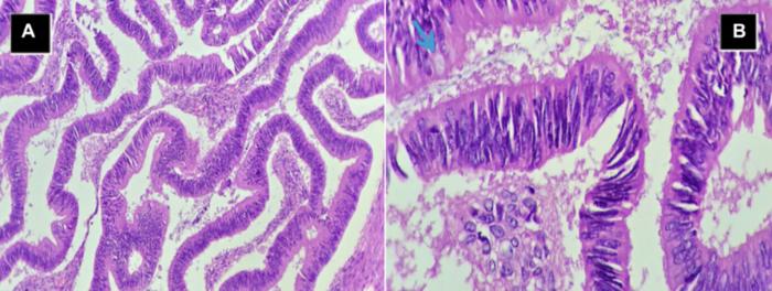 Deceptive clinical course of mucinous ovarian carcinoma mimicking pelvic abscess in a postmenopausal woman: An exceptional case report