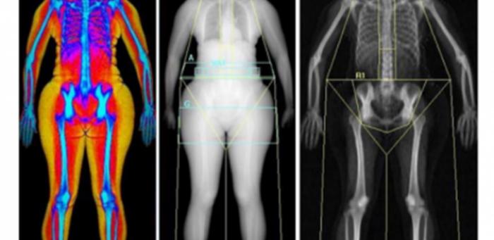 Abdominal fat is linked to a higher risk of urinary incontinence in women