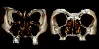 Maxillary Sinuses
