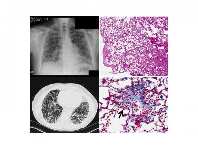 Mimicking Lung Disease