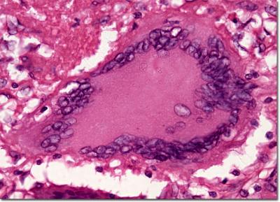 Tuberculosis