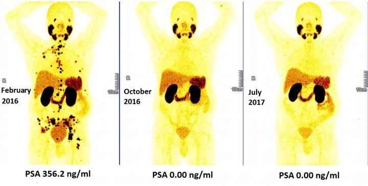 Persistent Complete Remission on Long-Term Follow-Up after Early Lu-177 Psma Radioligand Therapy