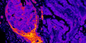 Breast vs. lung cancer metabolic signal