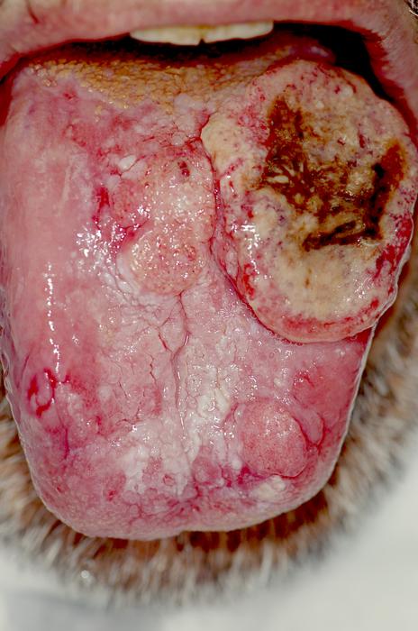 Distinct Molecular Subtypes of Oral Cancer