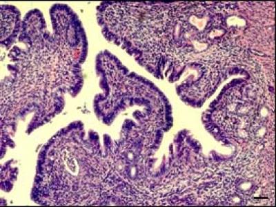 Endometriosis
