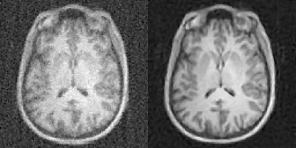 Artificial Intelligence to Improve the Quality of Medical Imaging