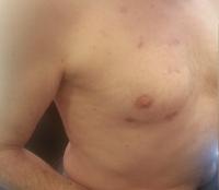 After TEAVR Surgery