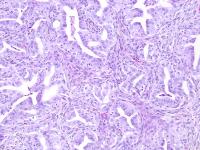 A Tumor Derived from Organoids of the Mouse Oviduct