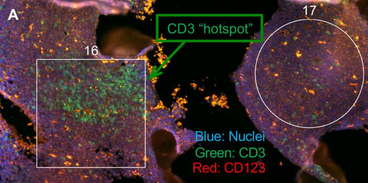 Leukemia Immune Profiles Predict Drug Resistance and Benefits of Immunotherapy (1 of 5)