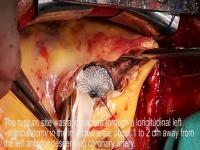 New Promising Surgical Technique for Heart Attacks