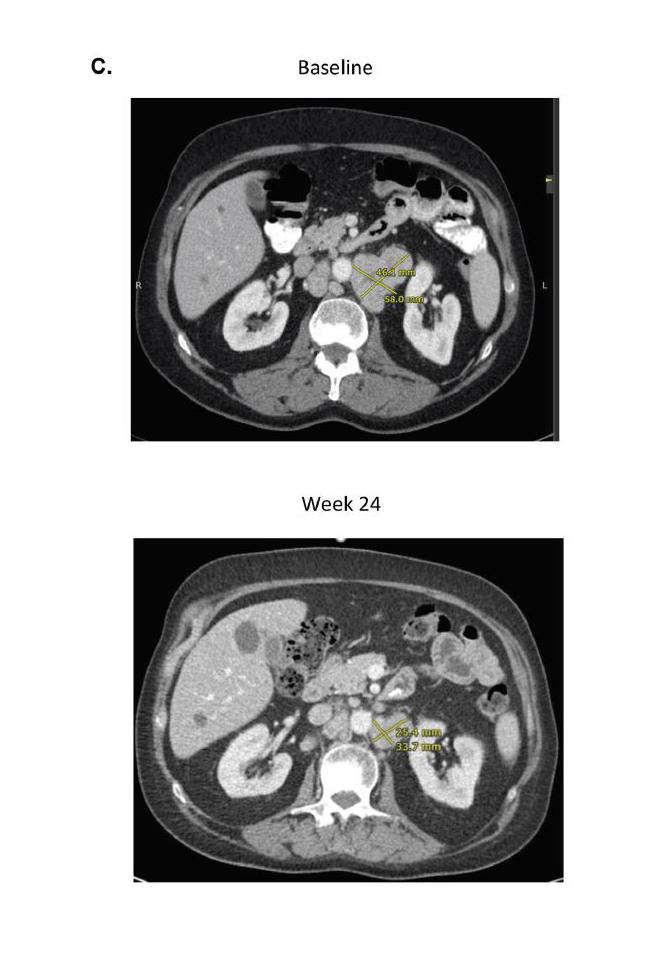 CT Scan