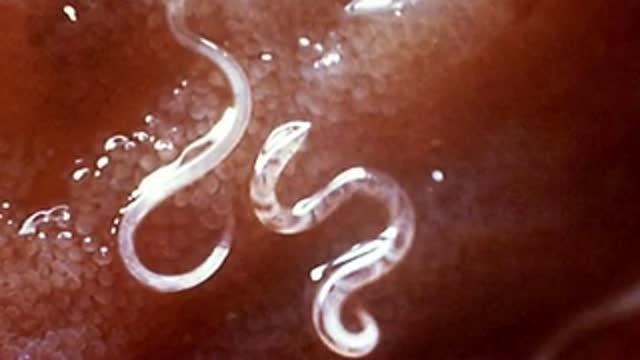 Filarial Diseases