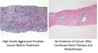 Gene Therapy