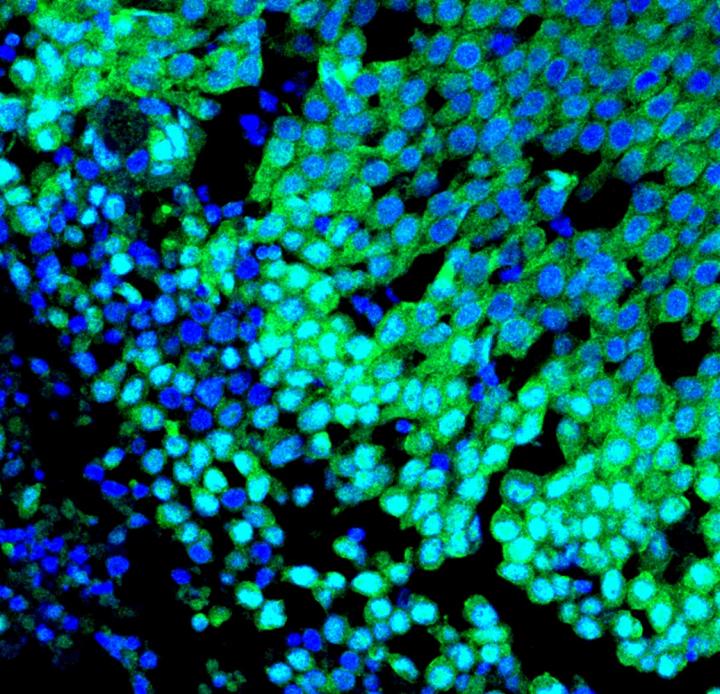 Basal-like breast tumour