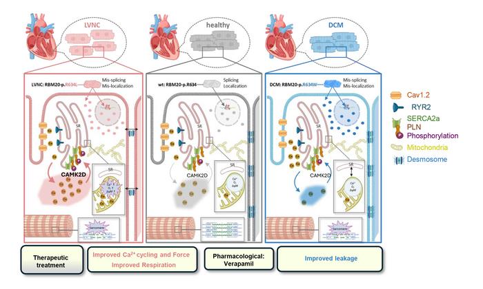 Cardiomyopathies DCM and LVNC