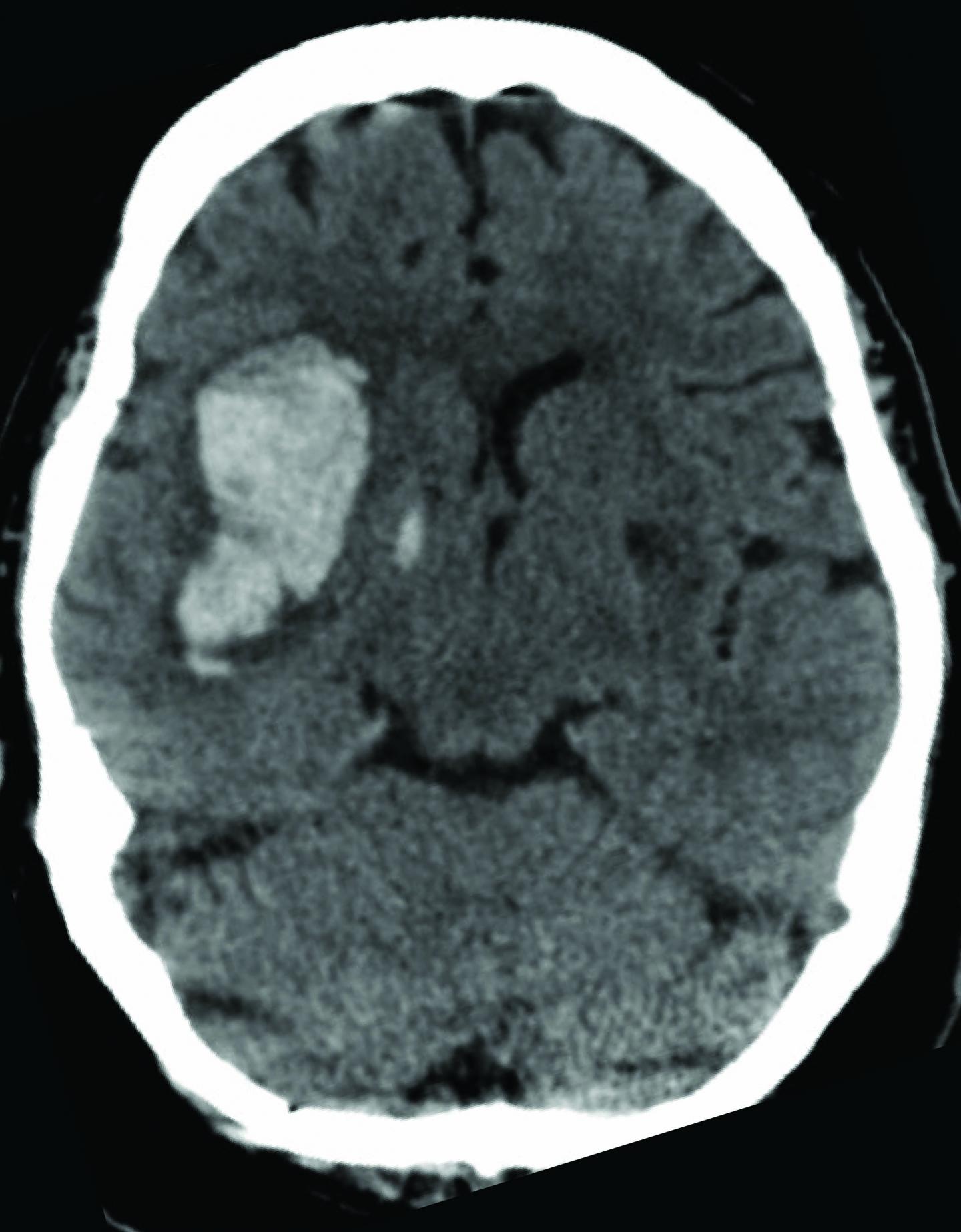 Bleeding Brain