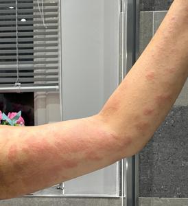 Asheema Kour shows the extent of her eczema
