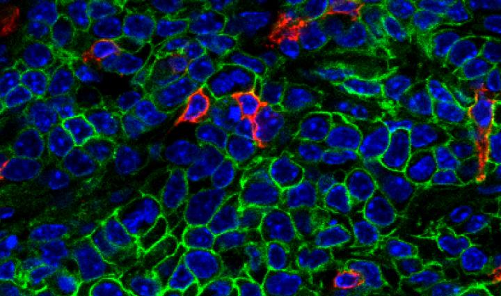T-Cells Infiltrating a Tumor