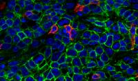 T-Cells Infiltrating a Tumor